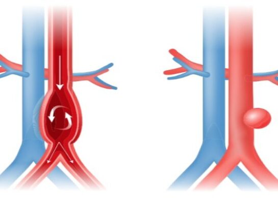 Dugotrajni ishod posle endovaskularne rekonstrukcije aneurizme abdominalne aorte